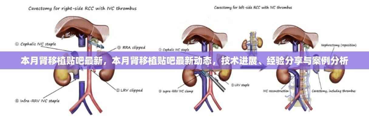 本月肾移植贴吧最新动态,技术进展、经验分享与案例分析全解析