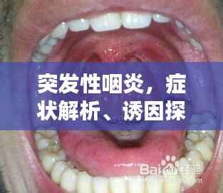 突发性咽炎，症状解析、诱因探究及应对良方